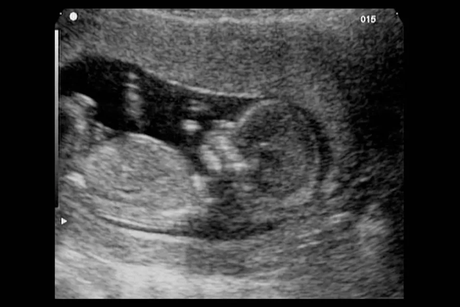 What to Expect at Your 12-Week Ultrasound